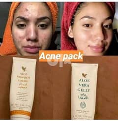 acne